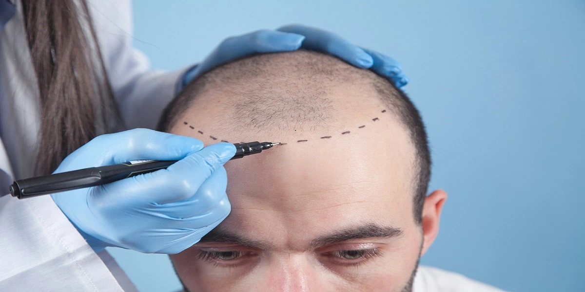 زراعة الشعر في جدة، المملكة العربية السعودية ترميم الشعر