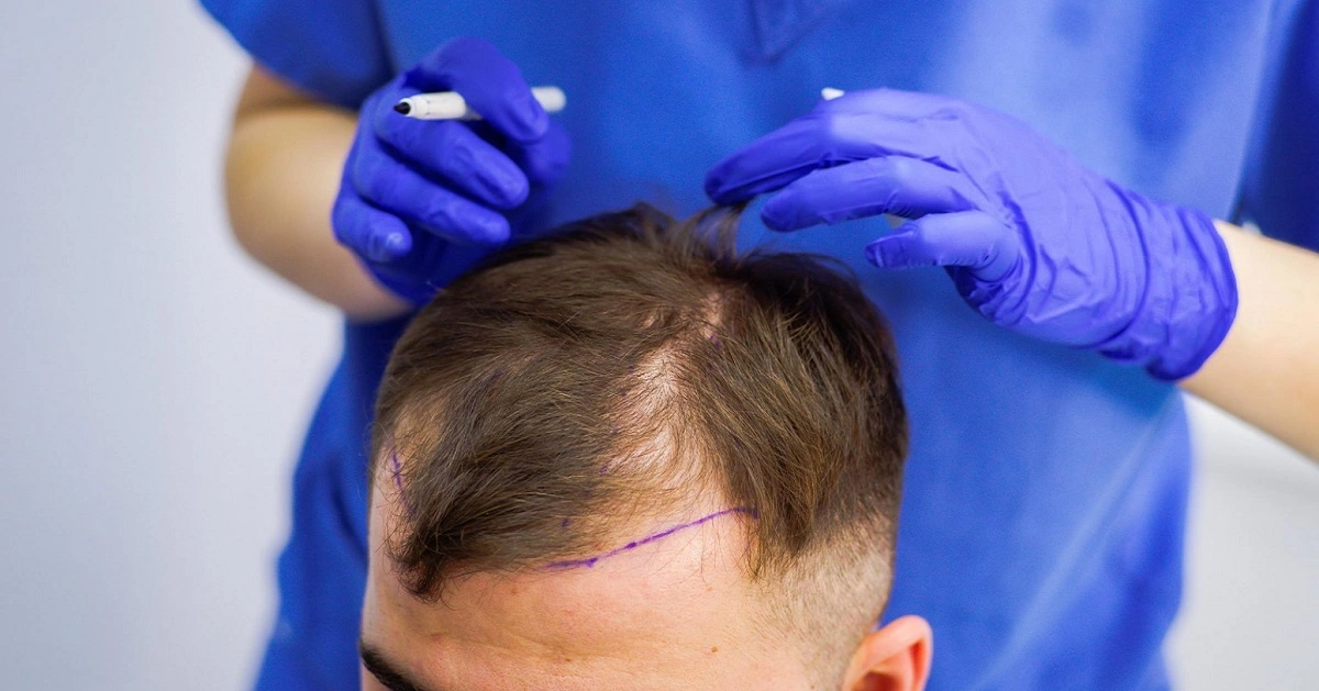 تكلفة زراعة الشعر في جدة