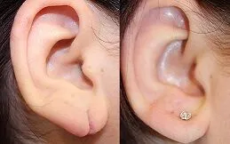 Ear Piercing Clinic in Jeddah