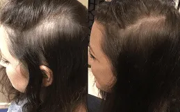 prp hair treatment before and after