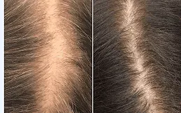 prp hair treatment results