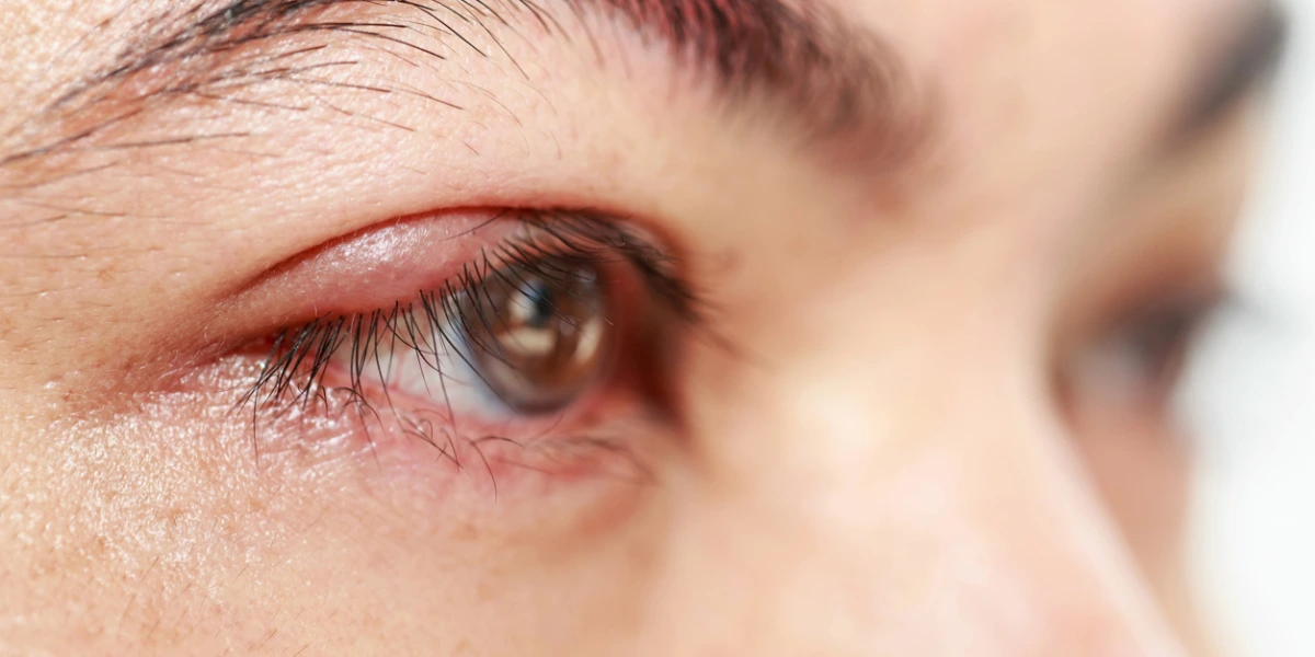 How To Get Rid Of A Stye Fast?